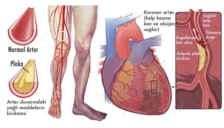 Ldl Kolesterol Düşüklüğü Ldl Kolesterol Düşüklüğü