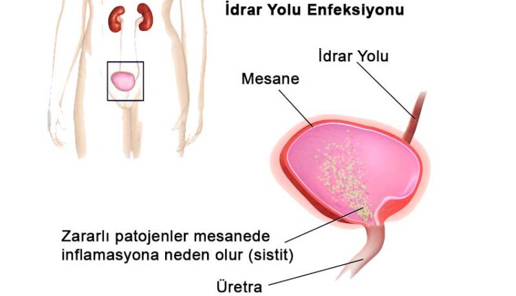 İdrarda Lökosit Yüksekliği ve İdrar Yolu Enfeksiyonu Belirtileri