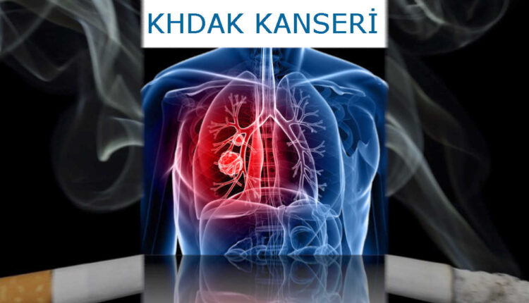 Küçük hücreli dışı akciğer kanseri, KHDAK tedavisi akciğer kanseri IV evre.