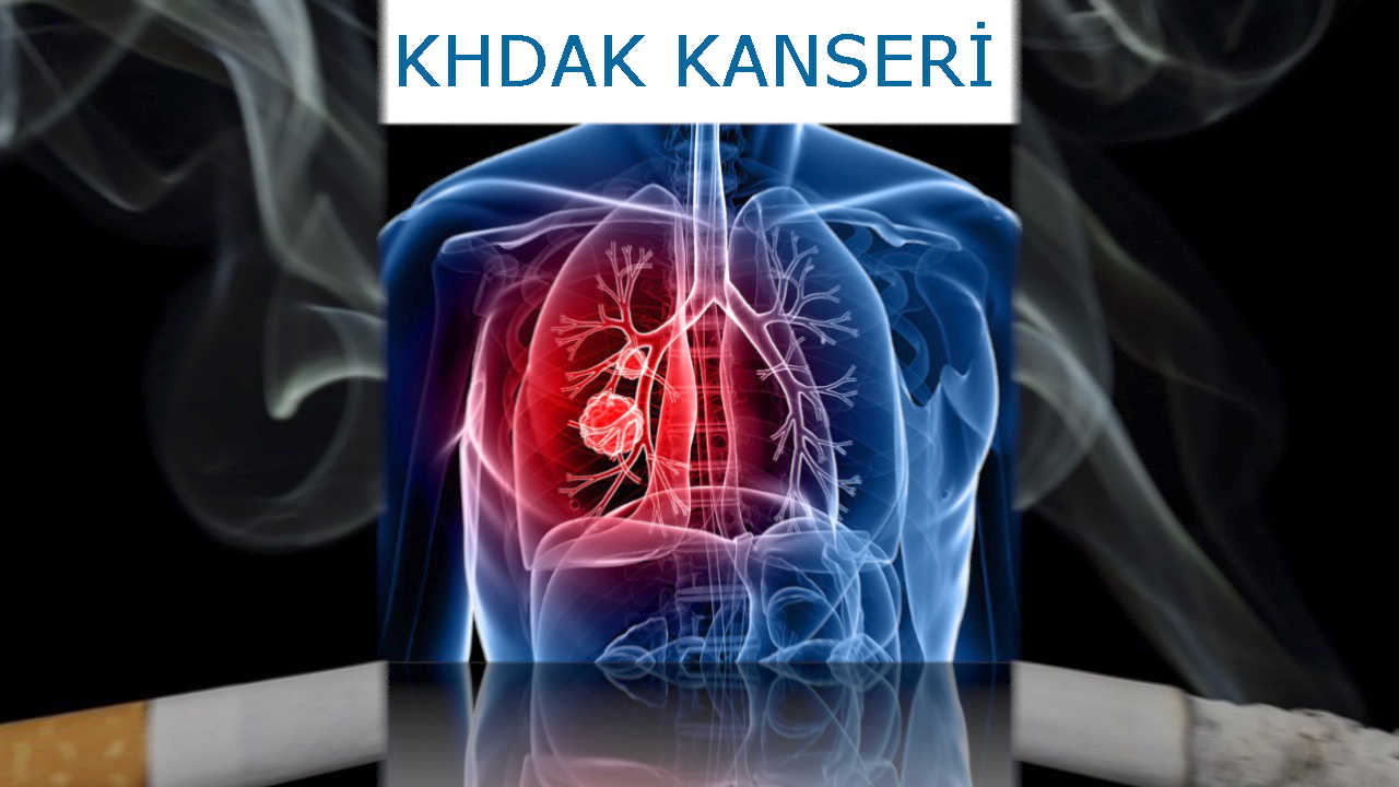 Akciğer kanseri aşamaları ile Etiketlenen Konular 22