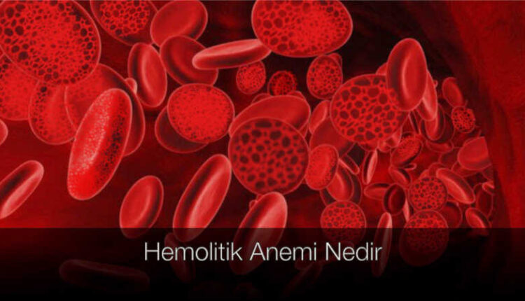 Hemolitik anemi nedir, Hemolitik anemi belirtileri, Hemolitik anemi nedenleri