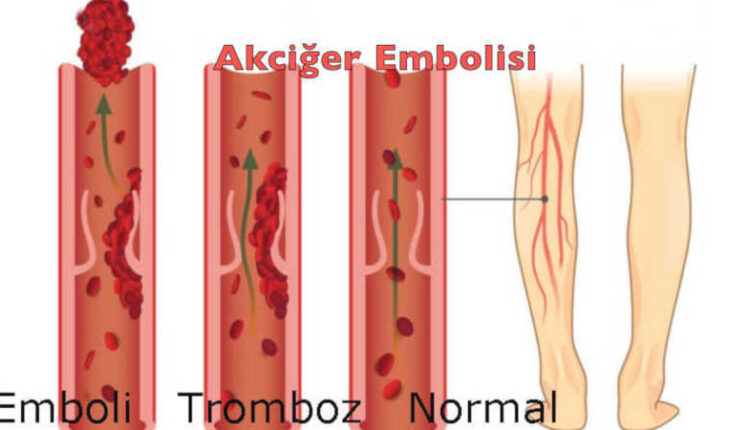 Akciğer embolisi nedir tedavisi | Derin ven trombozu akciğer embolisi | Pıhtı
