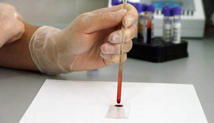 Anti HBs Nedir Değeri Kaç Olmalı Anti HBs Testi Nedir Kaç Günde Çıkar