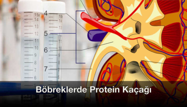 Böbreklerde protein kaçağı | idrarda protein normal değerleri | proteinüri