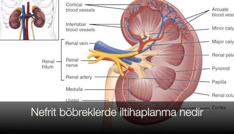 Nefrit nedir neden olur | Akut ve kronik böbrek iltihabı | Pyelonefrit nedir |