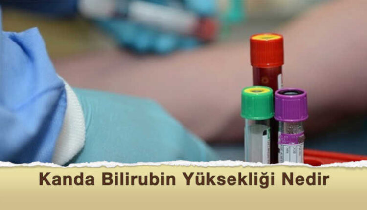 Bilirubin nedir | Bilirubin yüksekliği | Bilirubin nasıl düşürülür | Sarılık