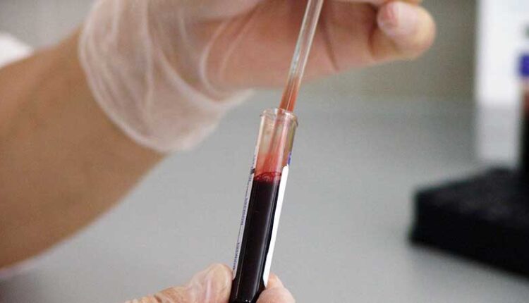 Anti Rubella testi (Kızamıkçık kan testi) Nedir Neden Yapılır?