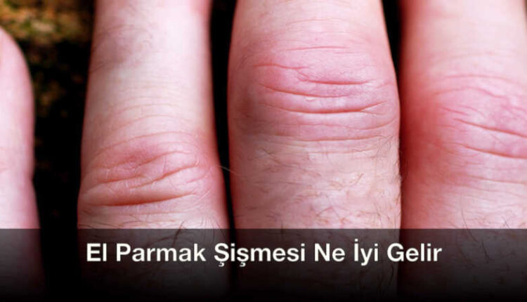 El parmak şişmesine ne iyi gelir El parmak ucu şişmesi Parmaklarda ödem