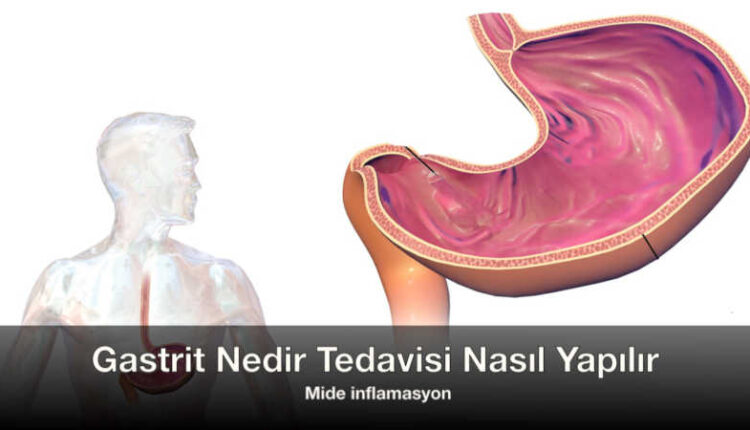 Gastrit nedir belirtileri | Mide inflamasyon nedir | Helikobakter Pilori Mikrobu